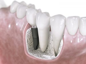Имплантация зубов 3D