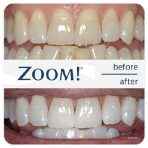 Zoom-3 отбеливание зубов