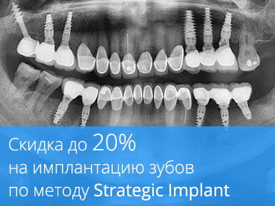 Скидка до 20% на имплантацию зубов по методу Strategic Implant!